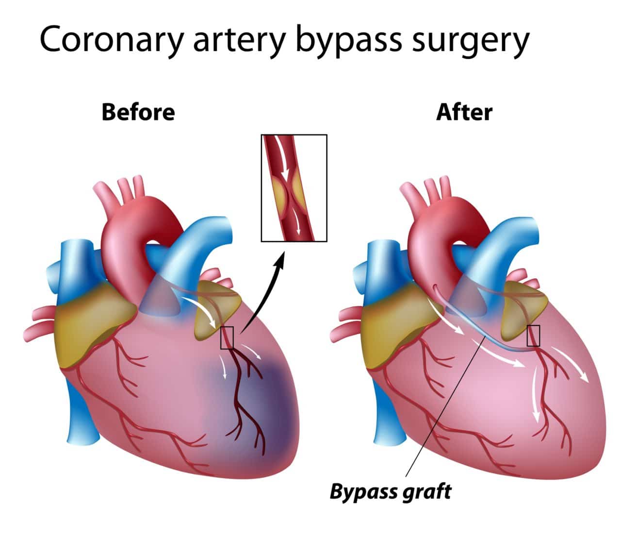 Coronary Artery Bypass Grafting Meaning