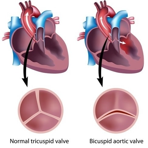 Aortic valve replacement
